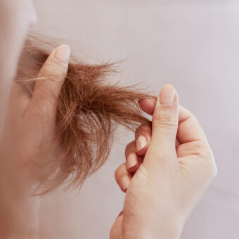 Eflúvio telógeno é um tipo de queda de cabelo excessiva ou pontual que pode ocorrer após mudanças no sistema imunológico.