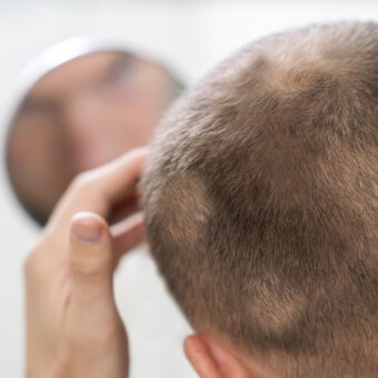É uma condição caracterizada pela perda de cabelo ou pelos em outras partes do corpo, em formatos arredondados ou ovais.